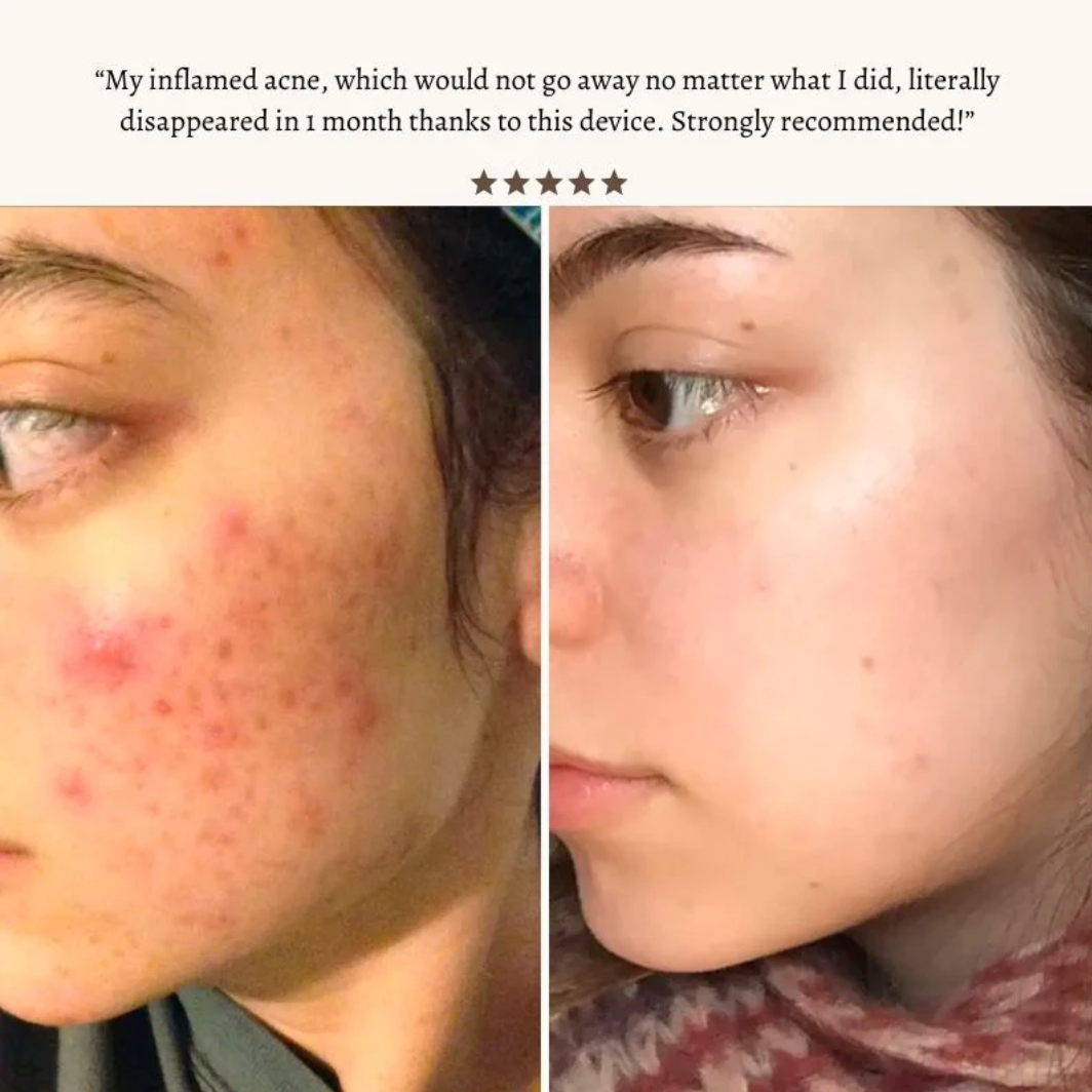 STIMULUX+™ Clinical High Frequency Wand